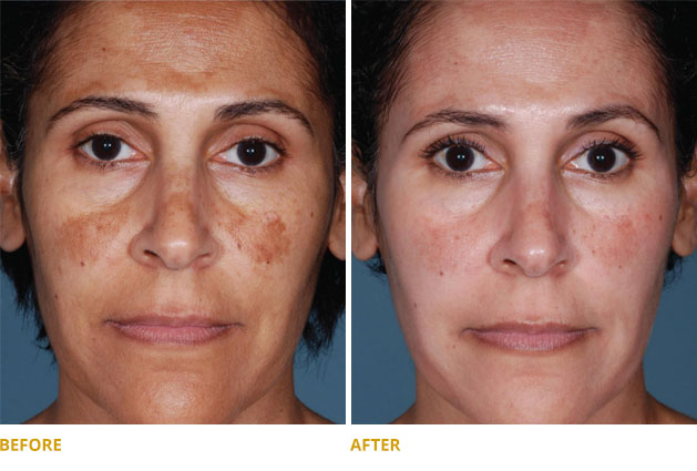Obagi Hyperpigmentation Treatments