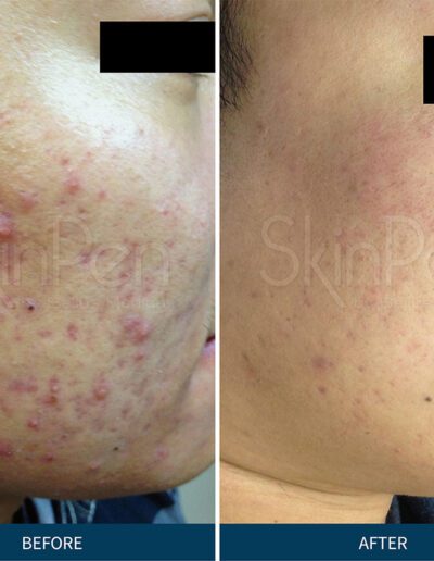Medical micro needling before and after